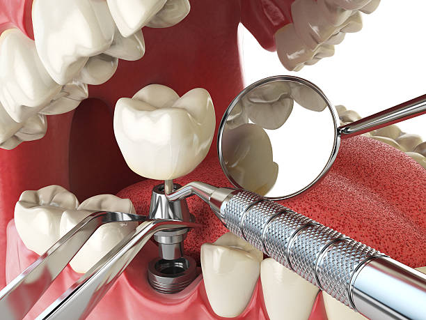 Best Emergency Dentist for Lost Fillings or Crowns in Waikele, HI